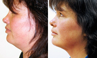 Коррекция овала лица, безоперационное уменьшение второго подбородка, пунктурное омоложение, Дао клиник, метод доктора Роганина.